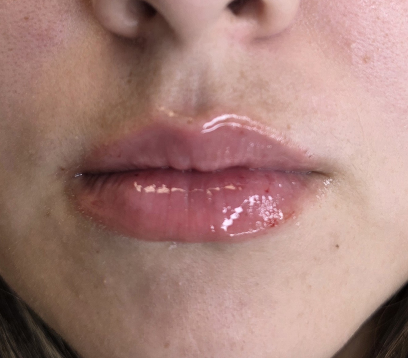 Lip Fillers After