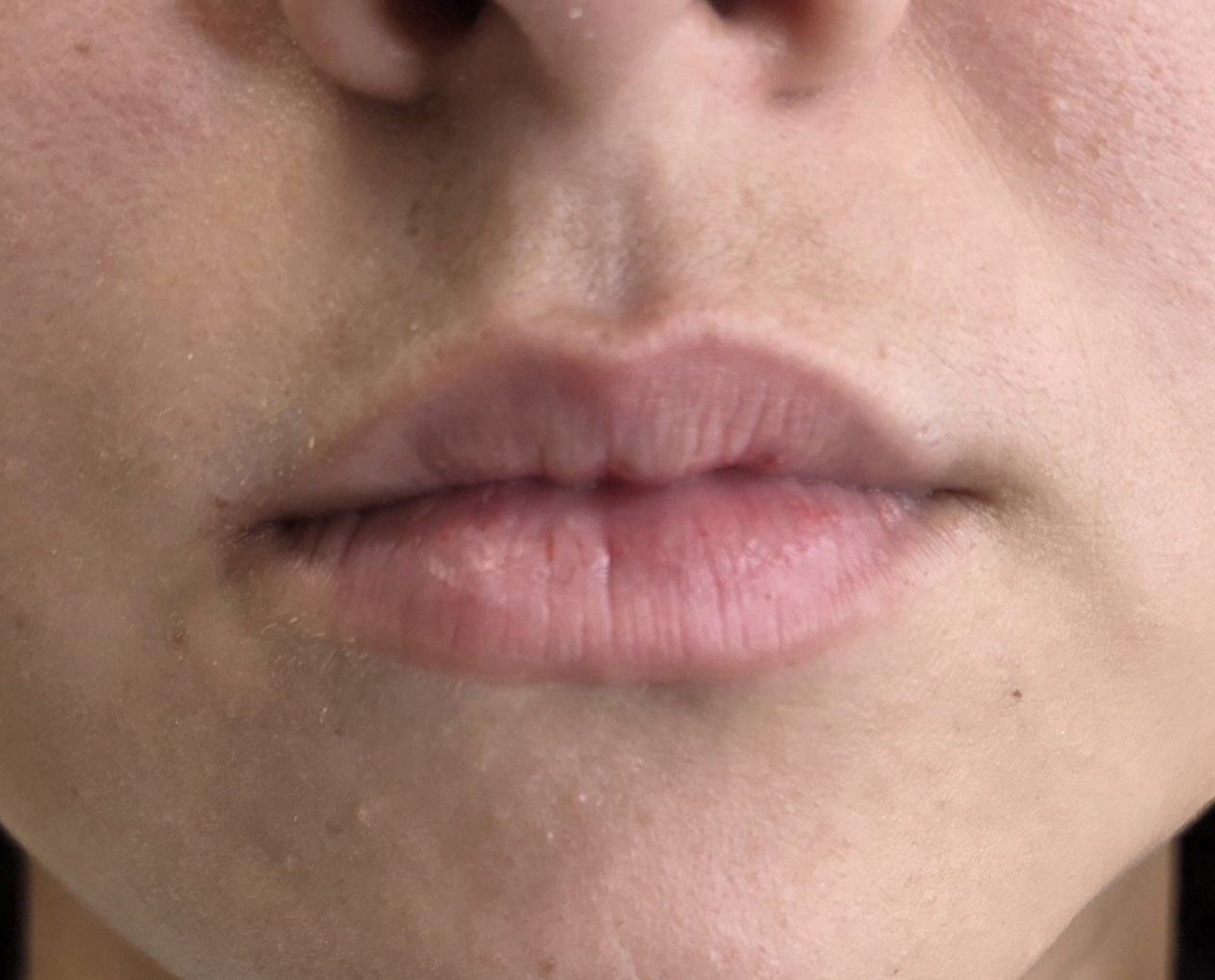 Lip Fillers Before