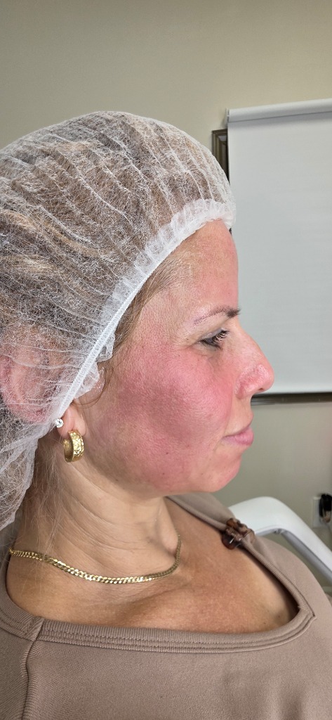 Skin Rejuvenation (Microneedling) After