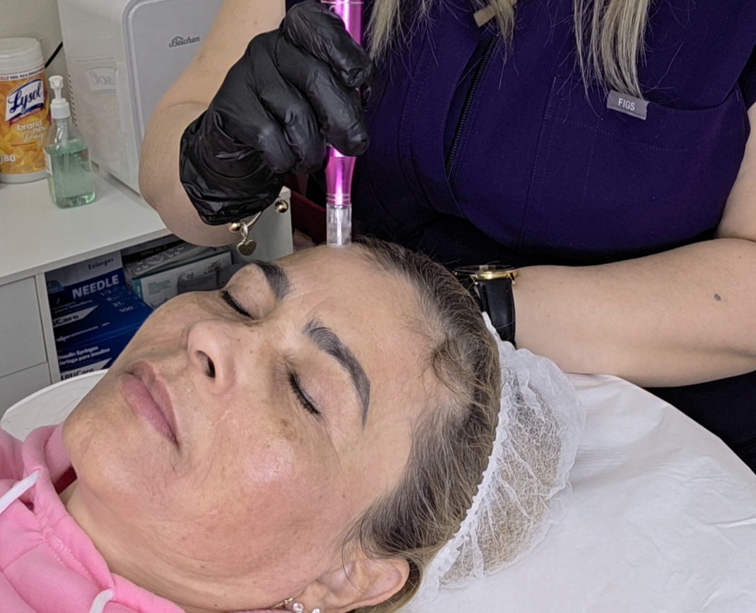 Microneedling